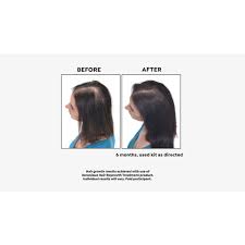 Keranique 5-piece 30-Day Hair Regrowth System | HSN
